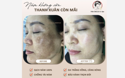 DỊCH VỤ ĐIỀU TRỊ NÁM – LẤY LẠI LÀN DA THANH XUÂN