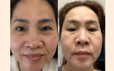 ĐIỀU TRỊ LÃO HÓA