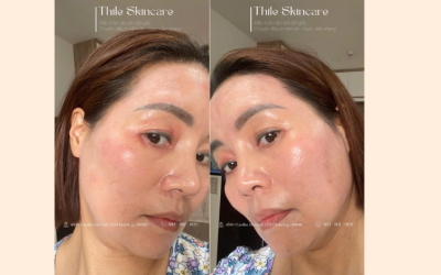 CHĂM SÓC DA SAU ĐIỀU TRỊ