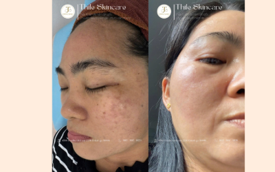 FACIAL CHUYÊN SÂU